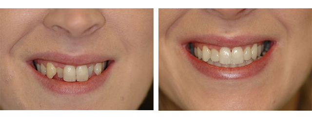 Advantages of Cfast | Future Dental Cairns