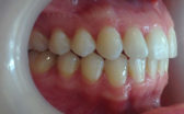 Case Study: Eloise’s Cfast orthodontics journey