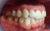 Case Study: Eloise’s Cfast orthodontics journey