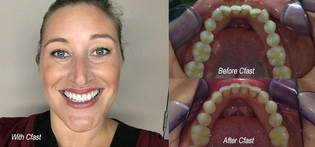 Cfast orthodontic treatment Cairns