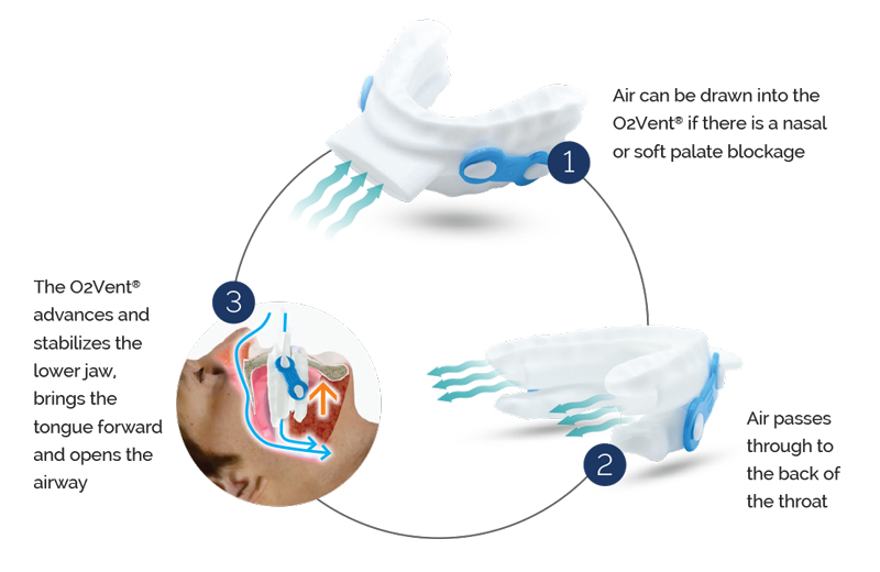oventus-how-o2vent-works
