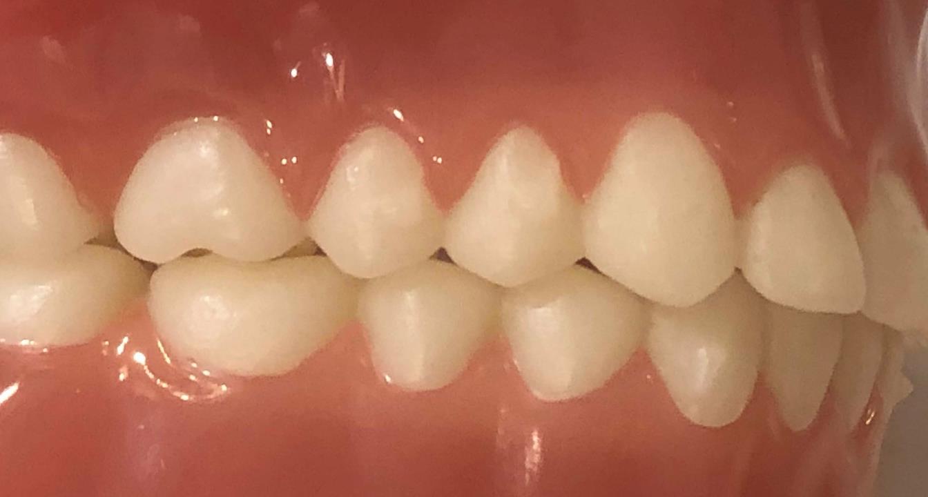 Occlusal Splint Therapy
