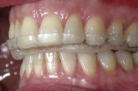 Occlusal Splint Therapy