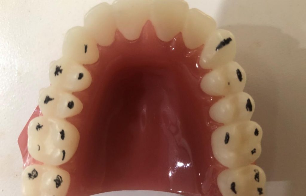 Occlusal Splint Therapy Cairns TMD Treatment Future Dental