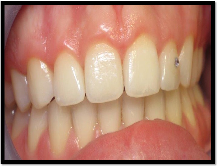 What is gummy smile treatment?