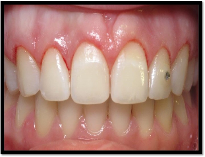 What is gummy smile treatment?
