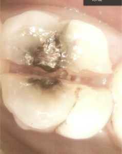 Amalgam Replacement