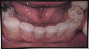 Incisal Wear