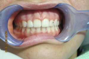 Cosmetic Gingivoplasty Cases