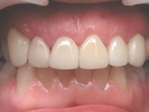 Cosmetic Gingivoplasty Cases