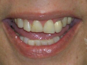 Cosmetic Gingivoplasty Cases