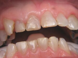 Cosmetic Gingivoplasty Cases