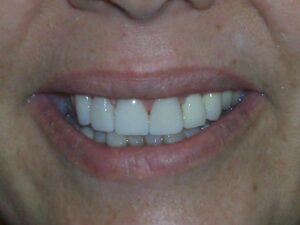 Cosmetic Gingivoplasty Cases
