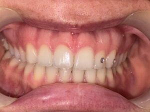 Cosmetic Gingivoplasty Cases
