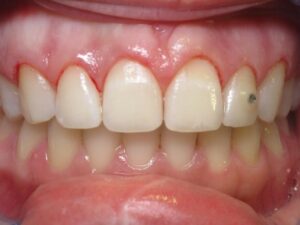 Cosmetic Gingivoplasty Cases