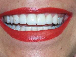 Cosmetic Gingivoplasty Cases