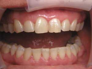 Cosmetic Gingivoplasty Cases