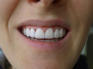 Cosmetic Gingivoplasty Cases