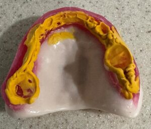 Thinking About new dentures?