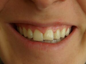 Cosmetic Gingivoplasty Cases