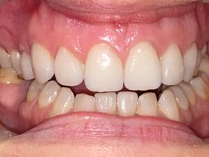 Cosmetic Gingivoplasty Cases