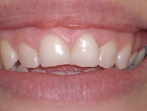 Cosmetic Gingivoplasty Cases