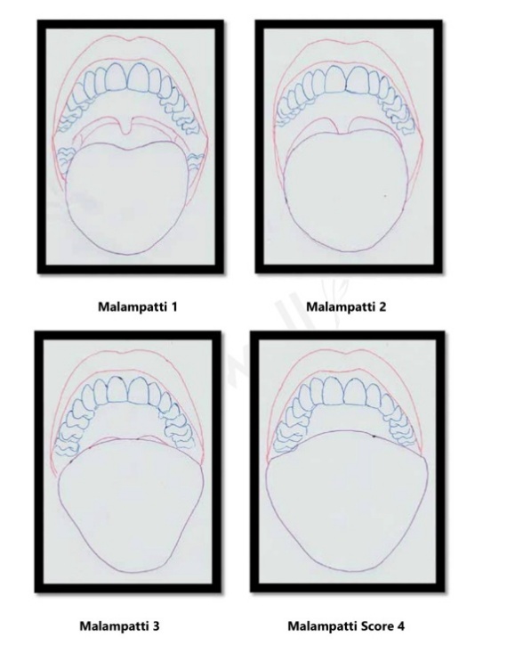 Mallampati score grades 1 to 4