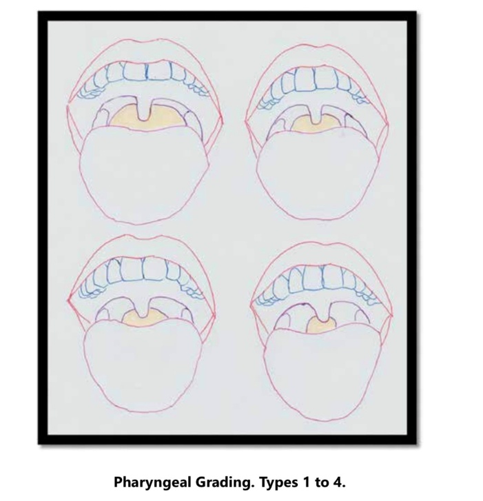 Pharyngeal grading types 1 to 4